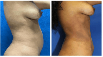 before and after